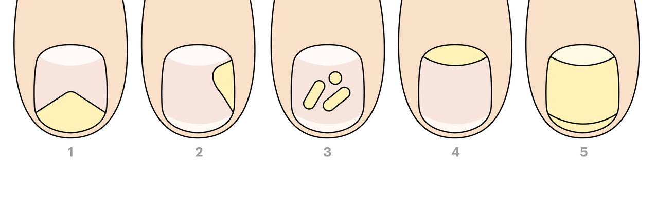 druhy plísní nehtů na nohou